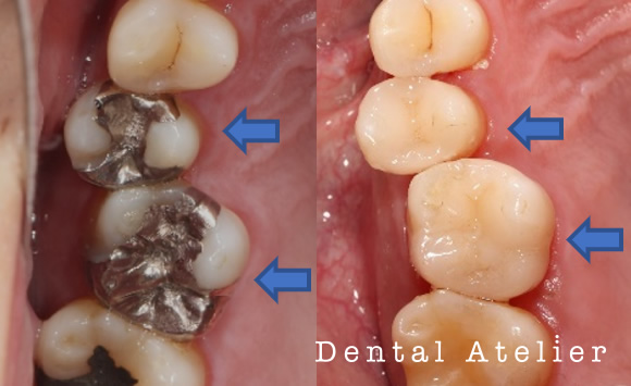 セラミックインレー