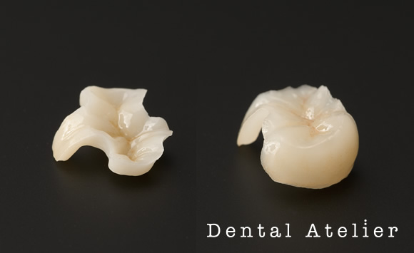 セラミックインレー