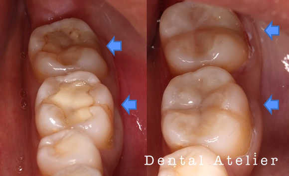 ダイレクトボンディング