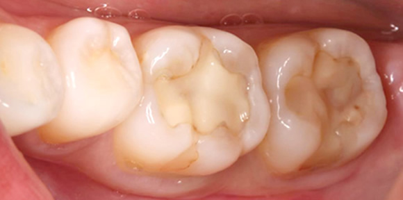 コンポジットレジン