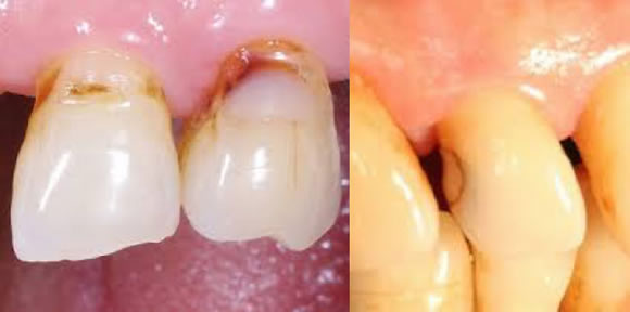 コンポジットレジン