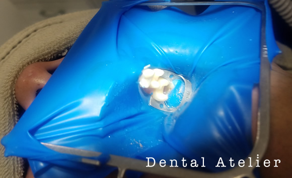 ラバーダム防湿