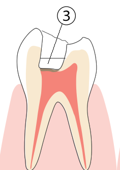MTAセメント仮封