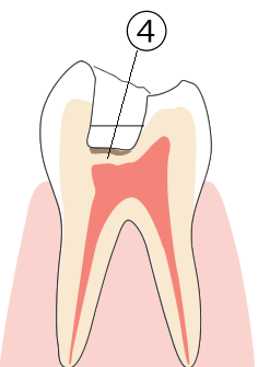 歯髄が象牙質に