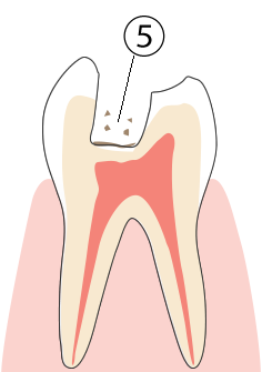 残りの虫歯部分を再度除去