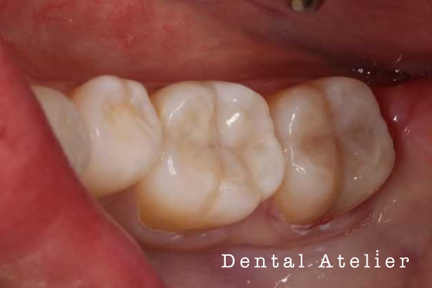 奥歯の自由診療の例