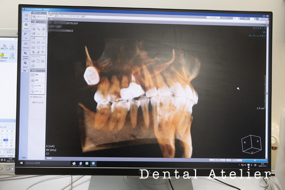 ３Ｄ治療シミュレーション