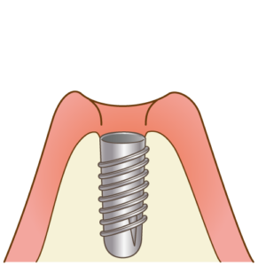 インプラント診断と治療計画