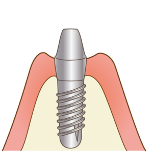 インプラント二次手術