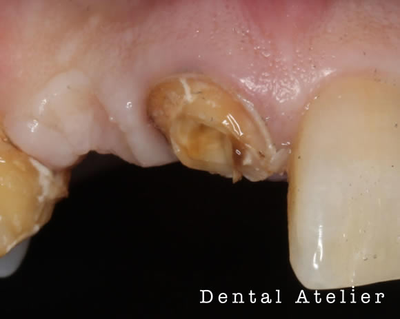 神経をとった歯