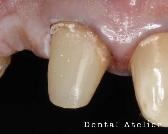 支台築造された歯