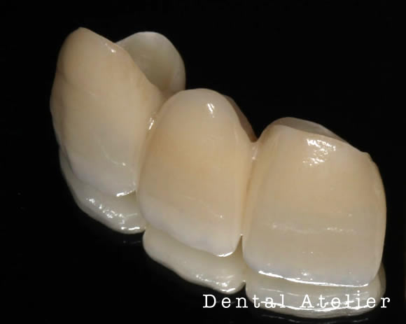 作られたセラミック歯