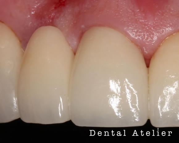 かぶせたセラミック歯