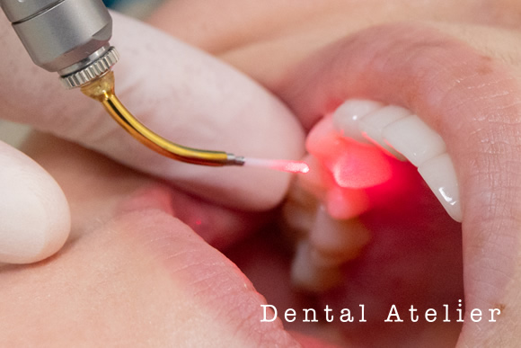 エルビウムヤグレーザー