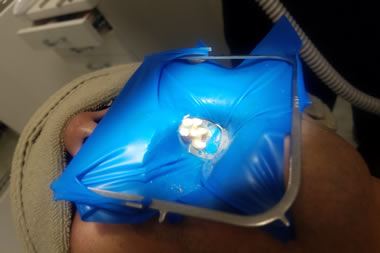 ラバーダム防湿