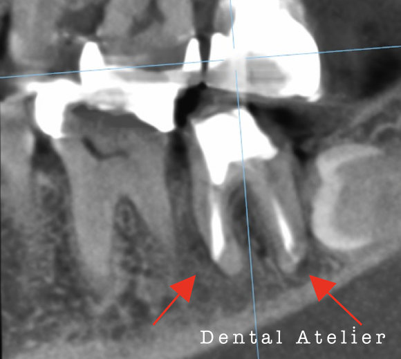 根管治療5か月後