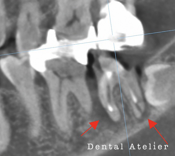 MTAセメント根管充填