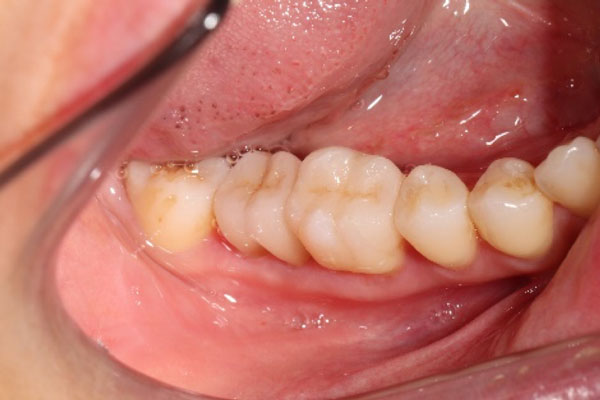 ラバーダム無し