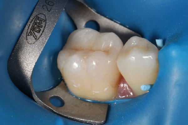 ラバーダム装着