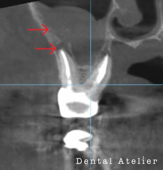 根管治療初診時