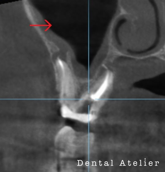 根管治療一か月後