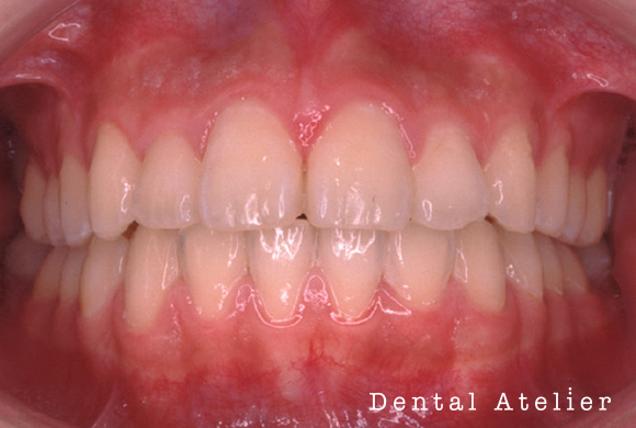 目立たない矯正