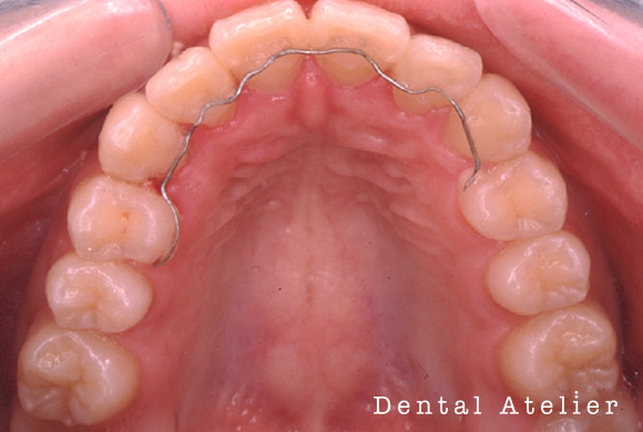 裏側リテーナー