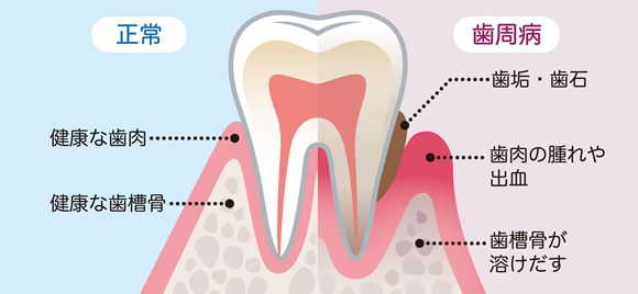 歯周病の原因