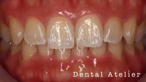 ホワイトニング術前