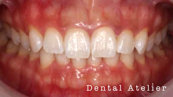 ホワイトニング術後