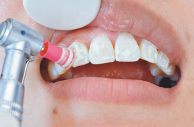 歯の表面をクリーニング