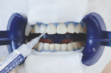 ホワイトニングジェル塗布