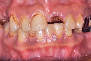 デンタルアトリエ自由が丘歯科　前歯から奥歯にかけてセラミック治療