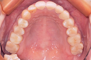 デンタルアトリエ自由が丘歯科　銀歯の除去・セラミック治療