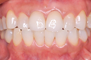 デンタルアトリエ自由が丘歯科　前歯のセラミック治療・ホワイトニング
