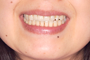 デンタルアトリエ自由が丘歯科　前歯のセラミック治療