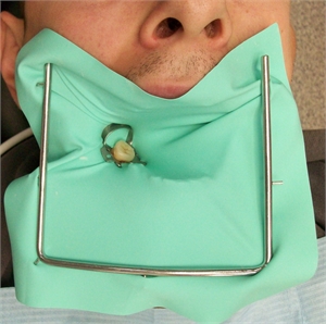 銀歯除去は注意が必要(金属アレルギーの方) | 自由が丘の歯医者の 