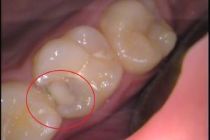 １０代女性 虫歯治療 自由が丘の歯医者のデンタルアトリエ自由が丘歯科です 審美歯科 かみ合わせ 歯列矯正 根管治療