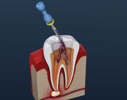 専門的な根の治療を受けたい