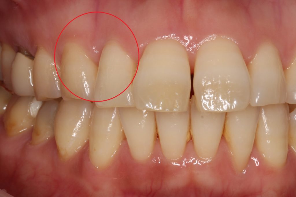歯周病の再生療法と レーザー治療 自由が丘の歯医者のデンタルアトリエ自由が丘歯科です 審美歯科 かみ合わせ 歯列矯正 根管治療