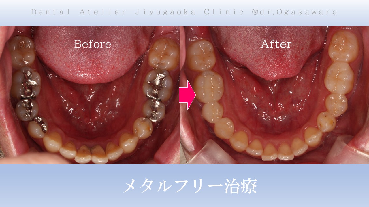 30代男性 銀歯全て除去。メタルフリー治療。 | 自由が丘の歯医者のデンタルアトリエ自由が丘歯科です。審美歯科（セラミック）、虫歯、根管治療