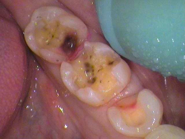 銀歯　虫歯