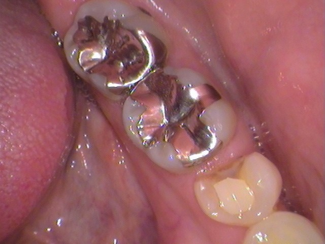 銀歯　虫歯
