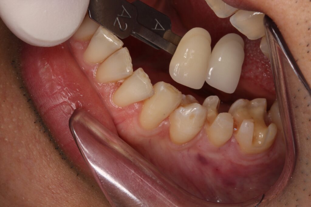 銀歯の中で虫歯