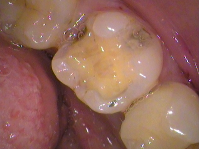 銀歯の中で虫歯
