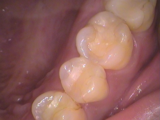 セラミックの虫歯