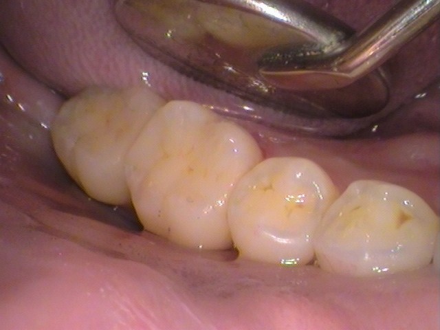 歯の間虫歯
