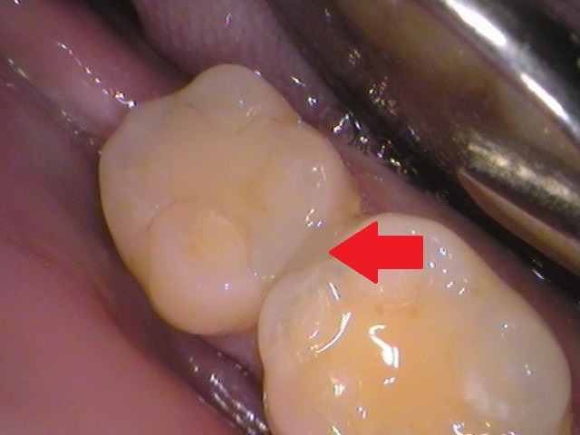 歯の間虫歯
