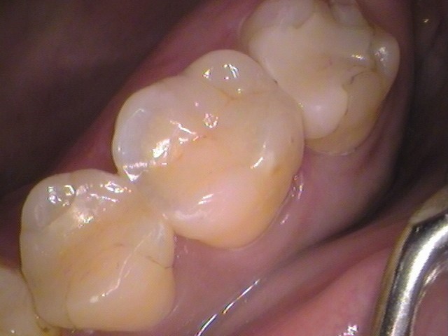 セラミックの虫歯