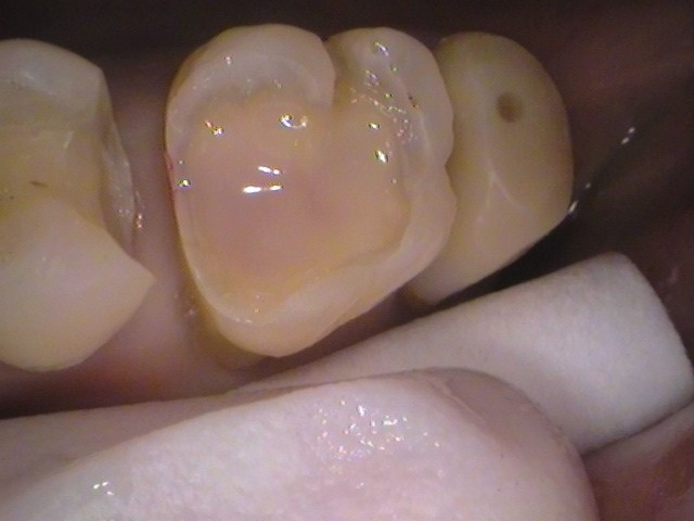 銀歯 虫歯 虫歯 セラミック